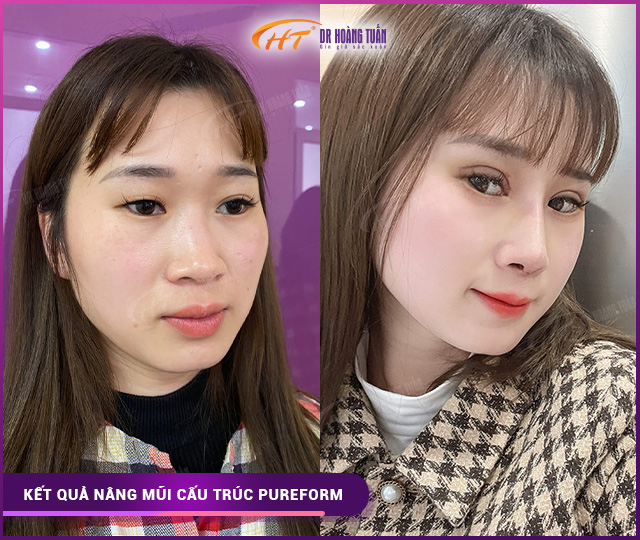 Hình ảnh kết quả nâng mũi cấu trúc pureform tại Dr Hoàng Tuấn