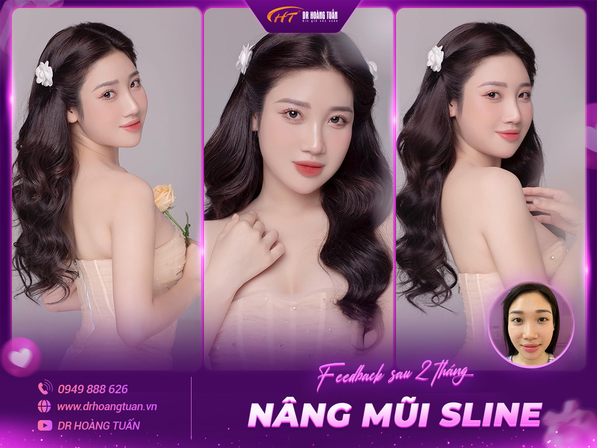 Hình ảnh kết quả khách hàng nâng mũi Sline