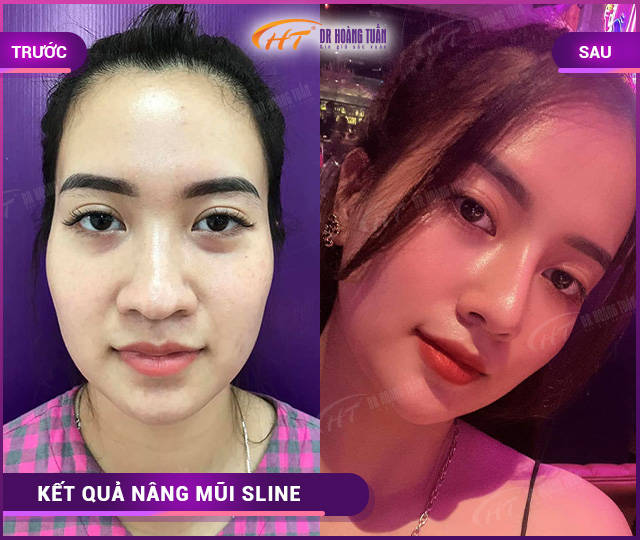 Hình ảnh kết quả khách hàng nâng mũi Sline