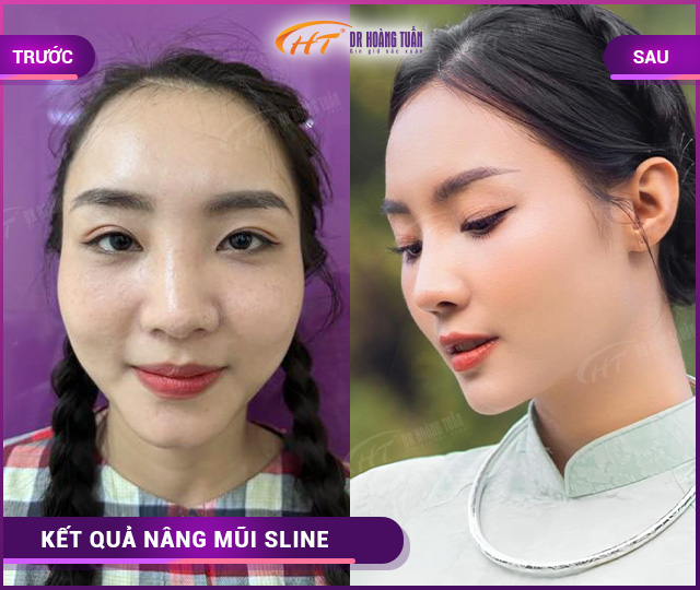 Hình ảnh kết quả khách hàng nâng mũi Sline