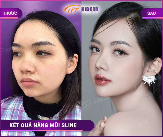 Hình ảnh kết quả khách hàng nâng mũi Sline