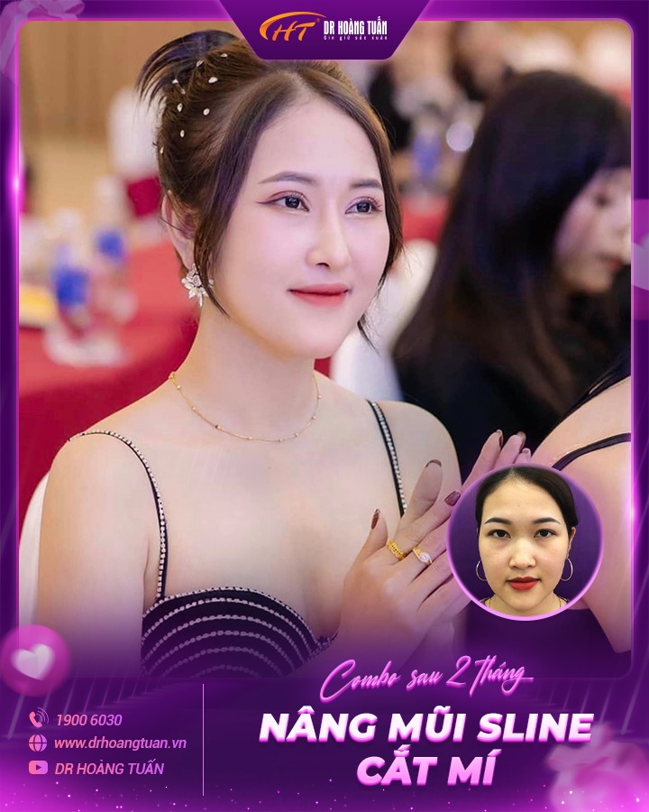 Hình ảnh kết quả khách hàng nâng mũi Sline