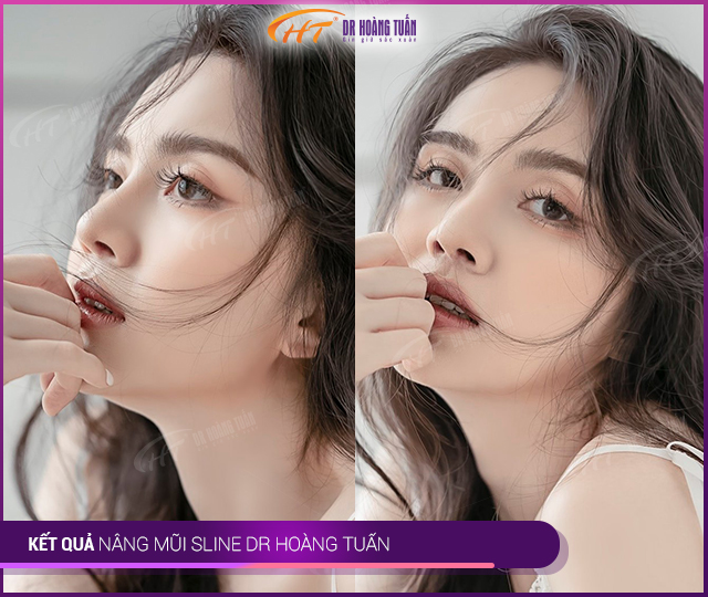 Hình ảnh kết quả khách hàng nâng mũi Sline