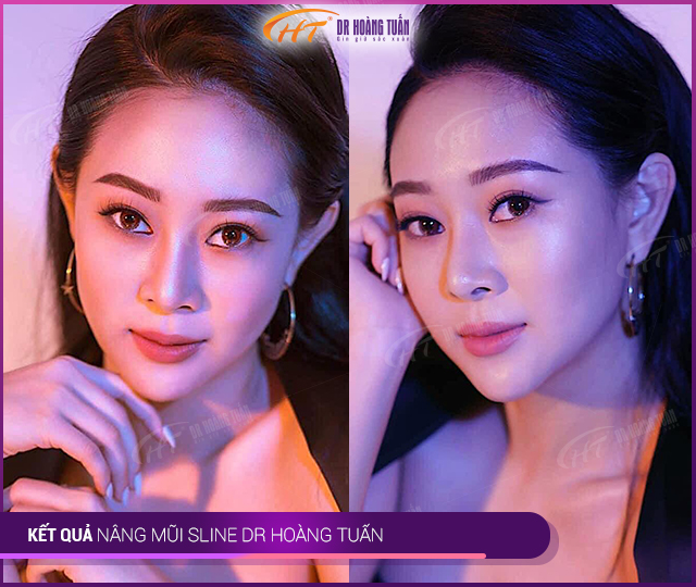 Hình ảnh kết quả khách hàng nâng mũi Sline