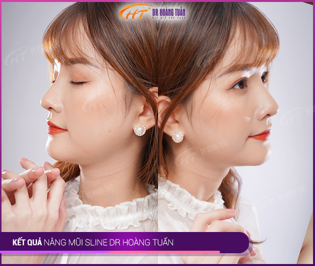 Hình ảnh kết quả khách hàng nâng mũi Sline