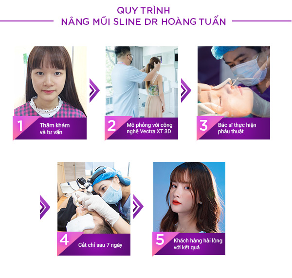 Quy trình nâng mũi Sline tại Dr Hoàng Tuấn
