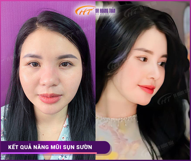 Kết quả nâng mũi sụn sườn tại Dr Hoàng Tuấn