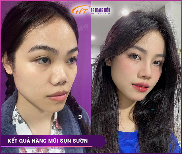 Hình ảnh kết quả nâng mũi sụn sườn tại Dr Hoàng Tuấn