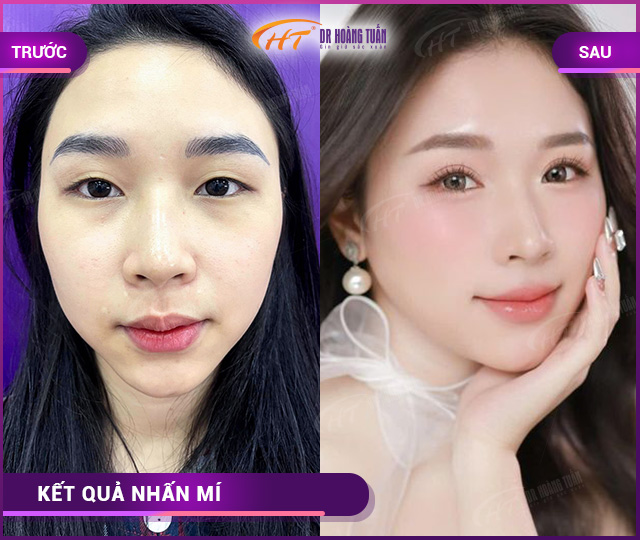 Hình ảnh kết quả khách hàng nhấn mí tại Dr Hoàng Tuấn