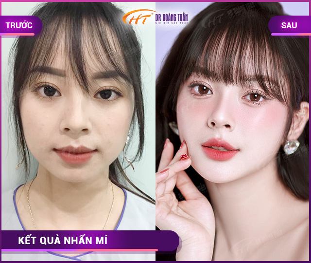Hình ảnh kết quả khách hàng nhấn mí tại Dr Hoàng Tuấn
