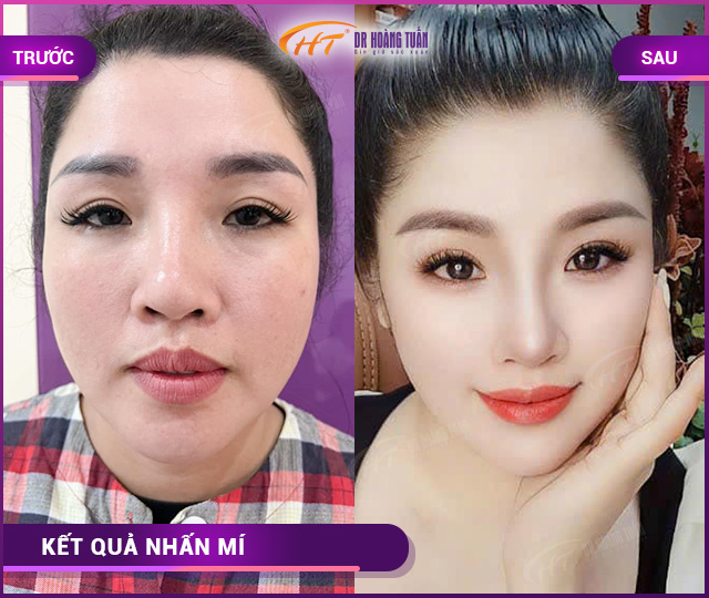 Hình ảnh kết quả khách hàng nhấn mí tại Dr Hoàng Tuấn