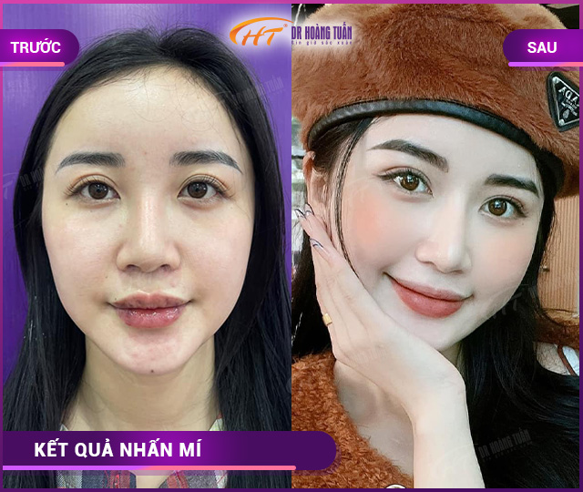 Hình ảnh khách hàng nhấn mí tại Dr Hoàng Tuấn 