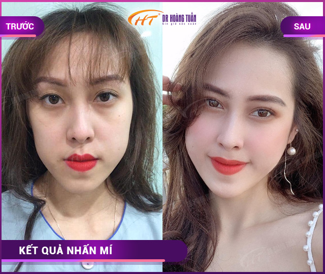 Hình ảnh kết quả khách hàng nhấn mí tại Dr Hoàng Tuấn