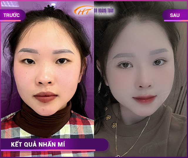 Hình ảnh kết quả khách hàng nhấn mí tại Dr Hoàng Tuấn
