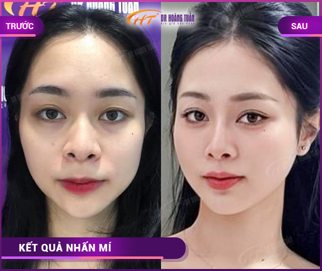 Hình ảnh kết quả khách hàng nhấn mí tại Dr Hoàng Tuấn