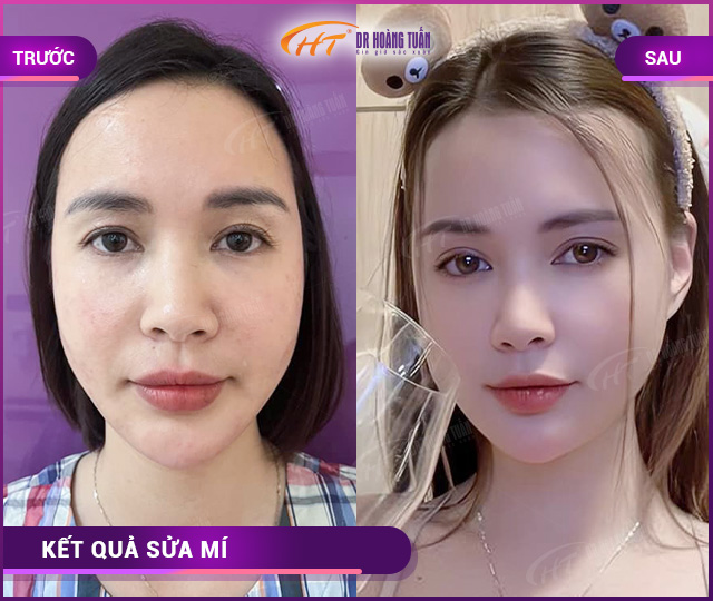 Hỉnh ảnh kết quả khách hàng sửa mí tại Dr Hoàng Tuấn