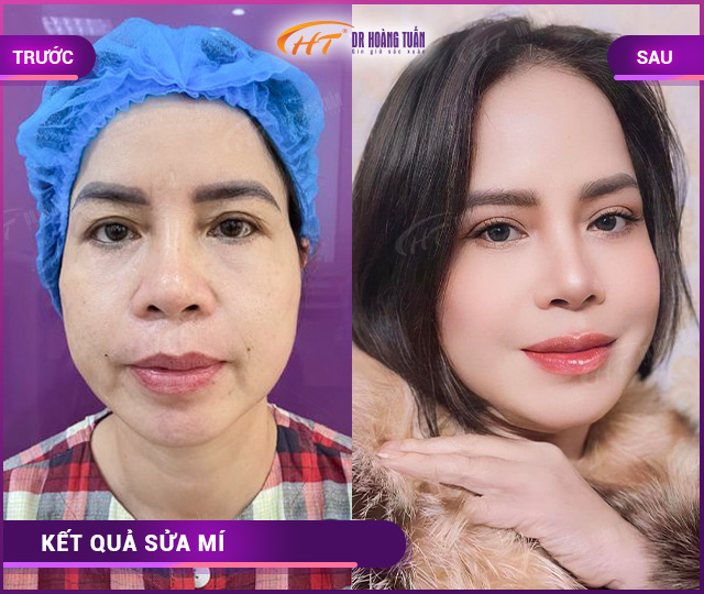 Hỉnh ảnh kết quả khách hàng sửa mí tại Dr Hoàng Tuấn