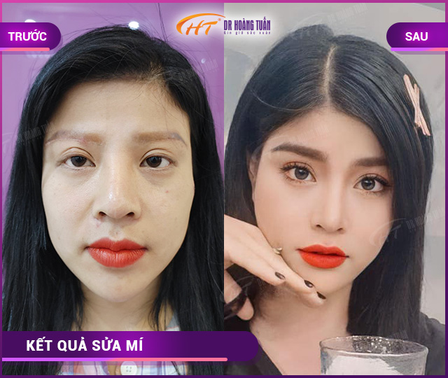 Hỉnh ảnh kết quả khách hàng sửa mí tại Dr Hoàng Tuấn