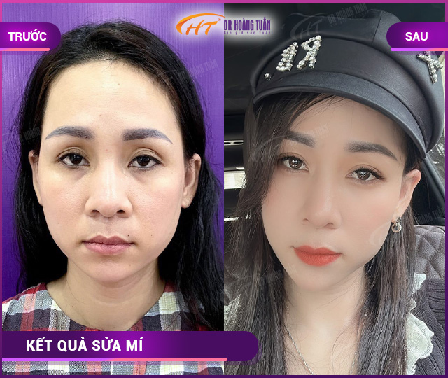 Hỉnh ảnh kết quả khách hàng sửa mí tại Dr Hoàng Tuấn