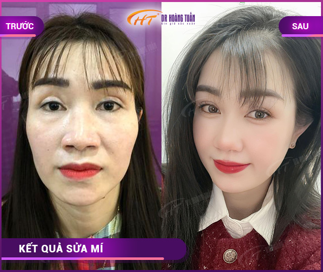 Hỉnh ảnh kết quả khách hàng sửa mí tại Dr Hoàng Tuấn