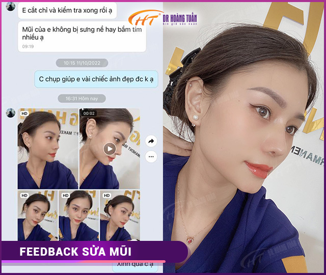 Feedback kết quả khách hàng sửa mũi tại Dr Hoàng Tuấn