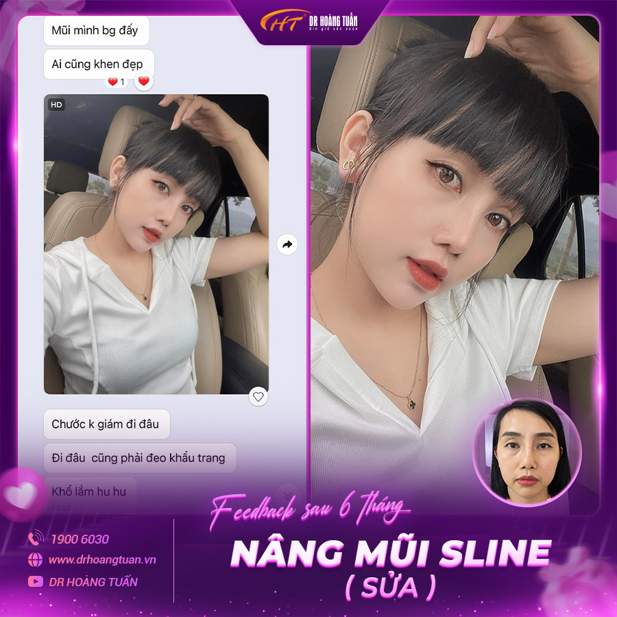 Feedback kết quả khách hàng sửa mũi tại Dr Hoàng Tuấn