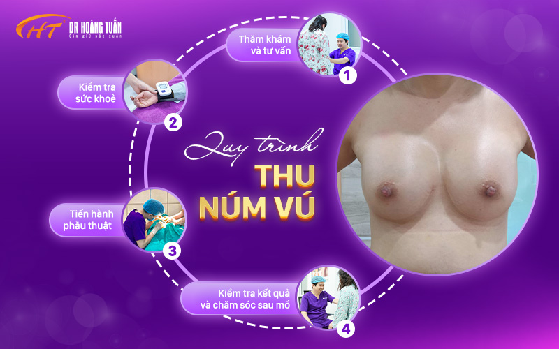 Quy trình thu gọn núm vú tại Dr Hoàng Tuấn