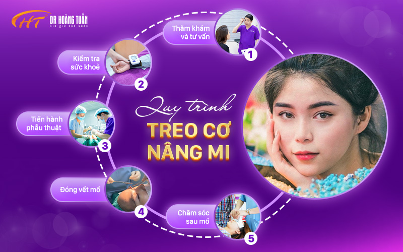Quy trình treo cơ nâng mí