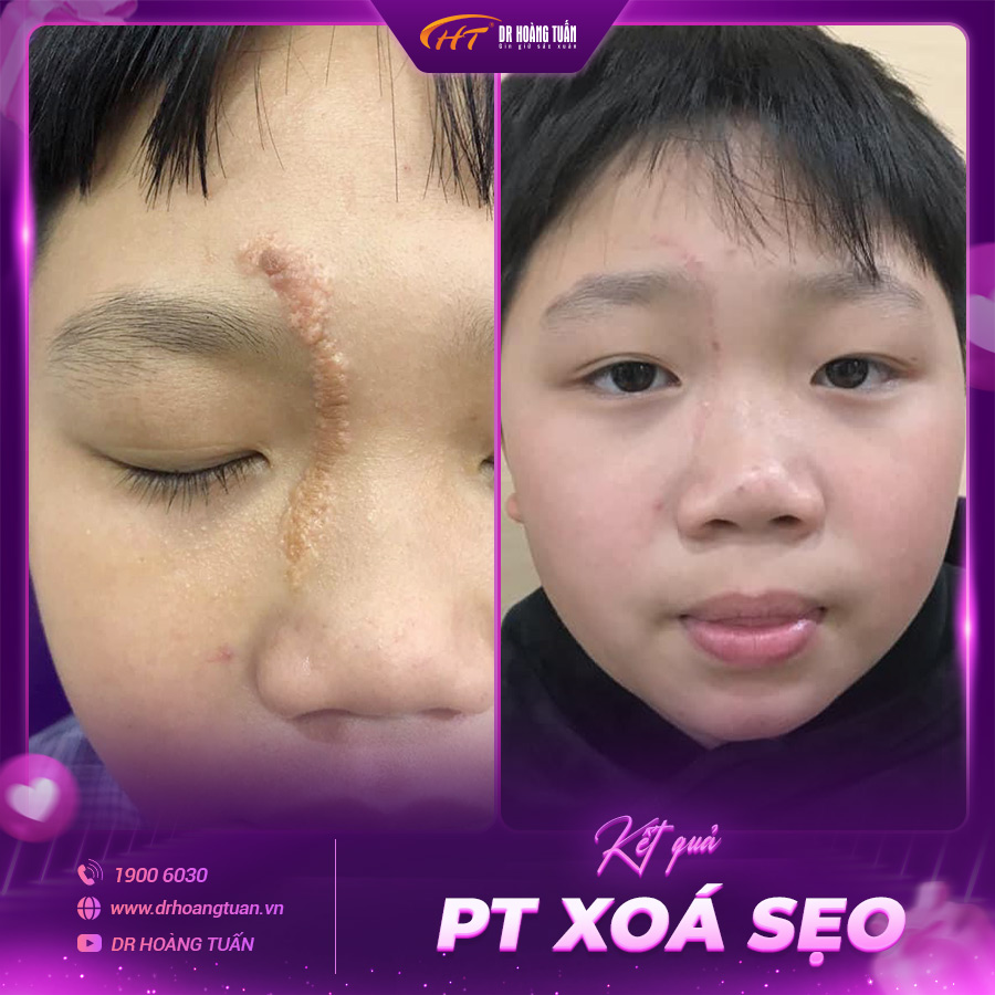 Hình ảnh kết quả xóa sẹo tại Dr Hoàng Tuấn