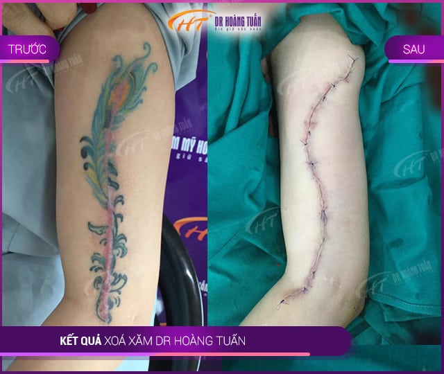 Hình ảnh kết quả xóa xăm tại Dr Hoàng Tuấn