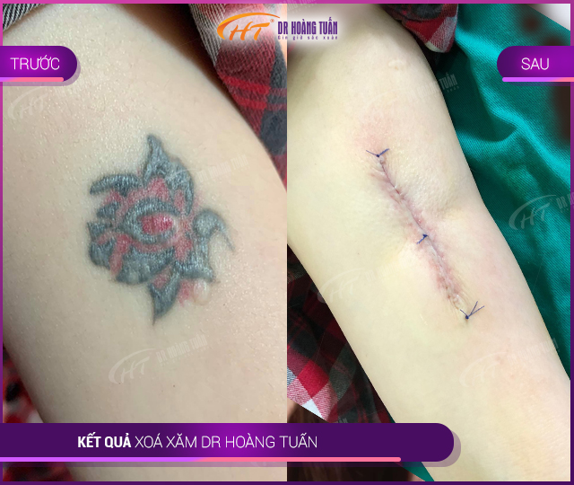 Hình ảnh kết quả xóa xăm tại Dr Hoàng Tuấn
