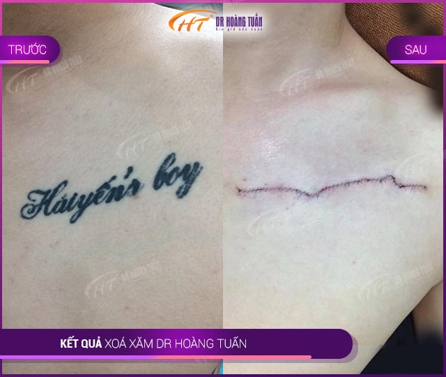 Hình ảnh kết quả xóa xăm tại Dr Hoàng Tuấn