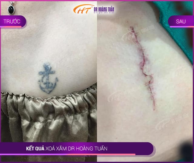 Hình ảnh kết quả xóa xăm tại Dr Hoàng Tuấn