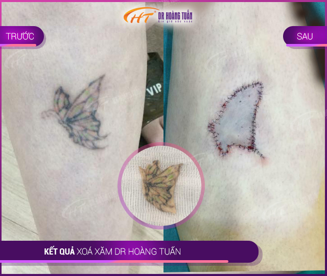 Hình ảnh kết quả xóa xăm tại Dr Hoàng Tuấn