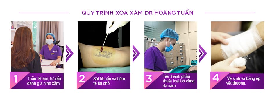 Quy trình phẫu thuật xóa xăm