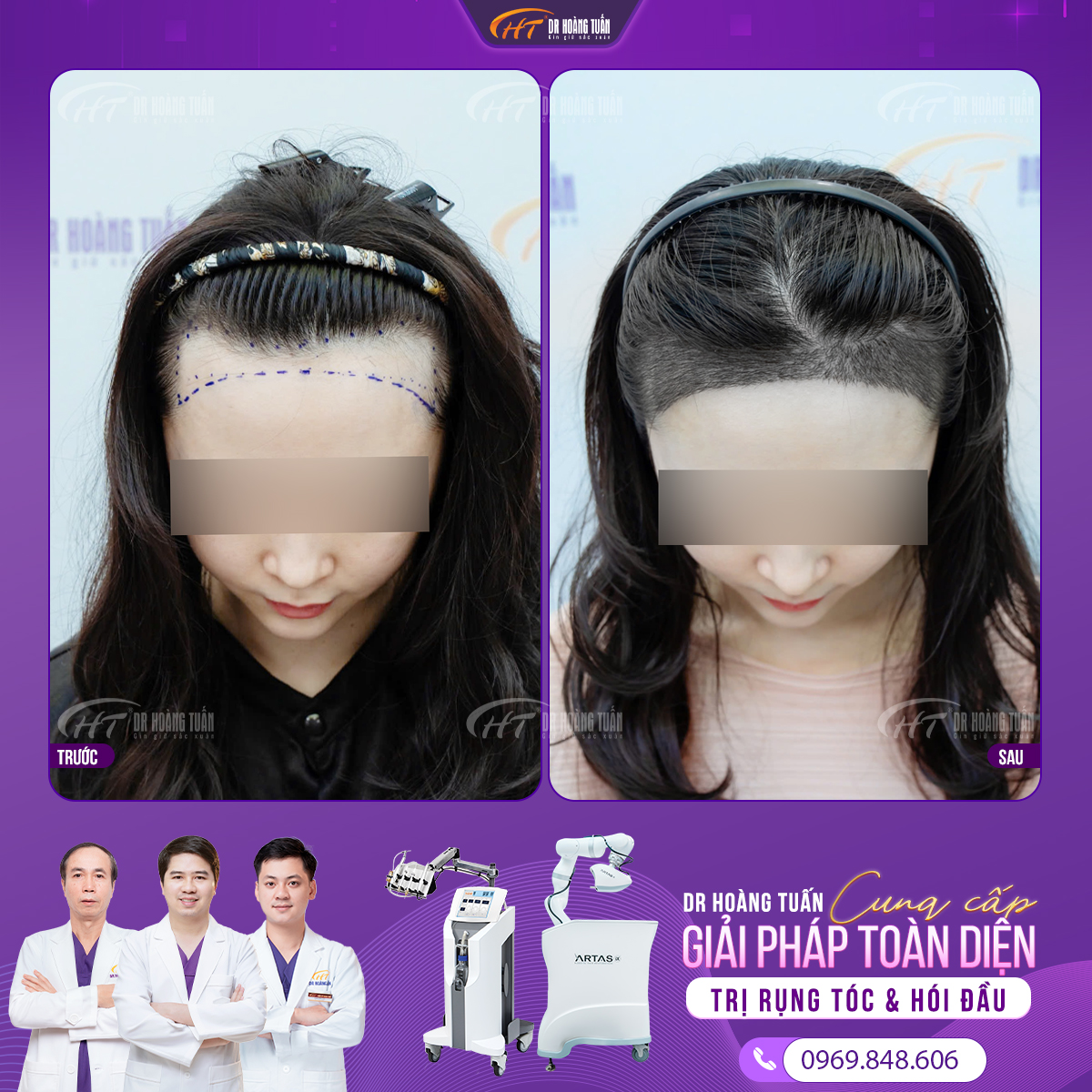 cấy tóc tự thân 