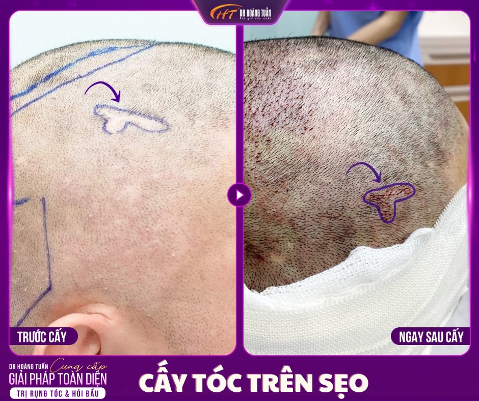 cấy sẹo tại DR hoàng tuấn