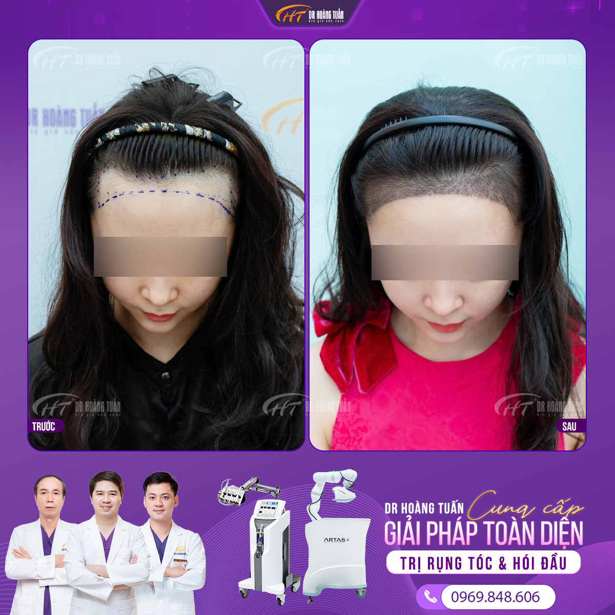 Cách tính số lượng nang tóc cần cấy