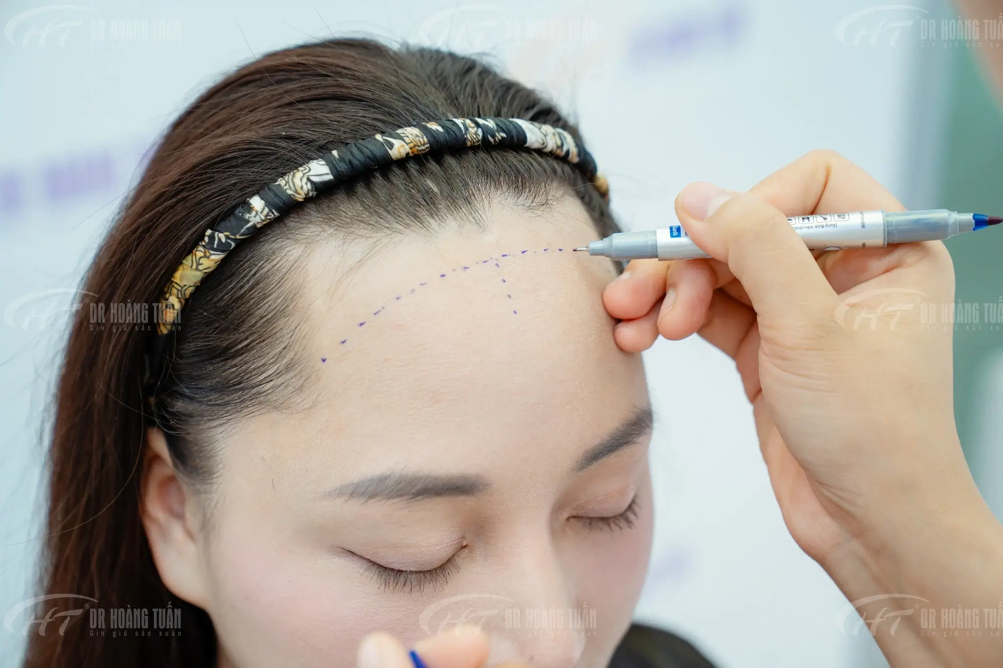 bác sĩ tính nang cấy tóc