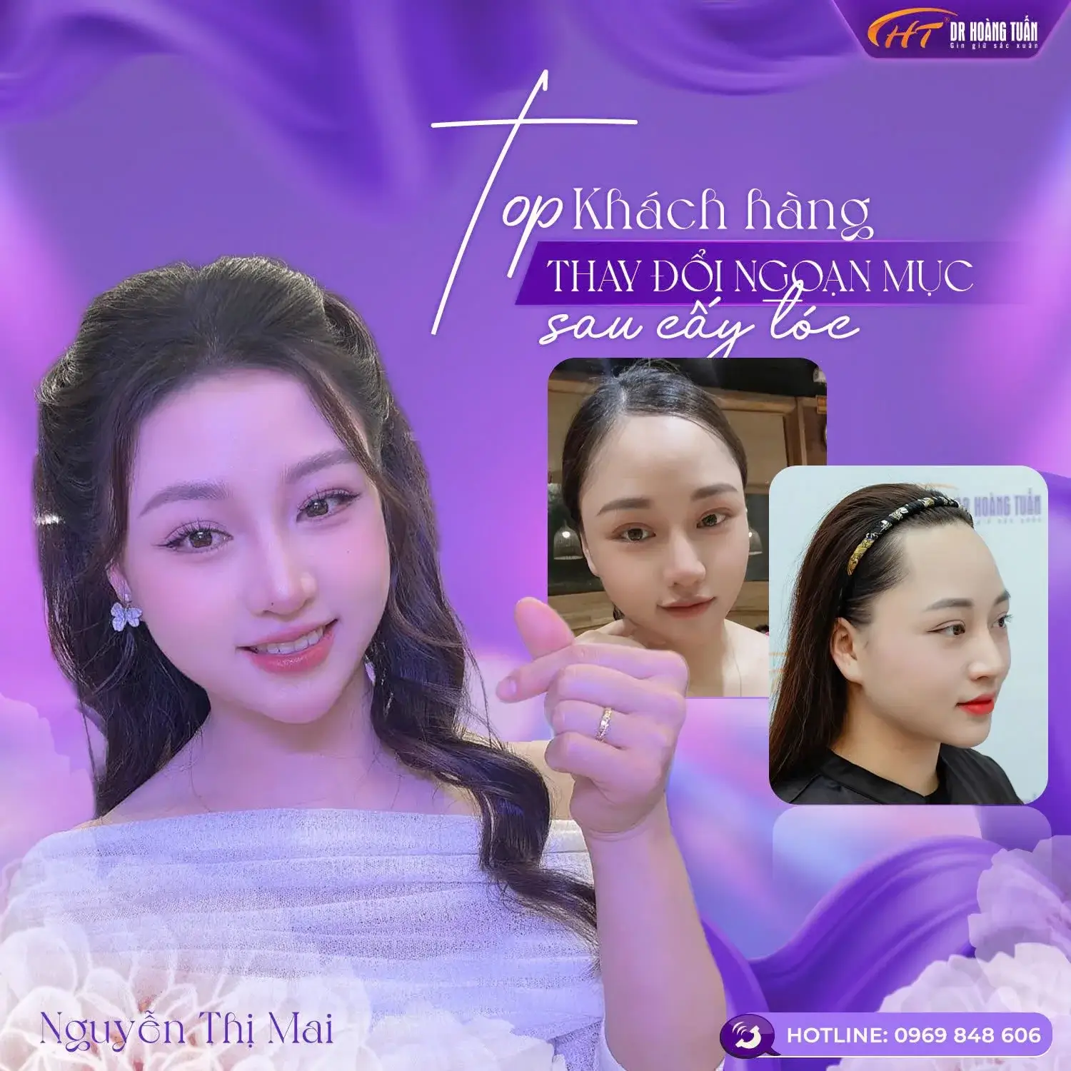 Có Nên Cấy Tóc Không