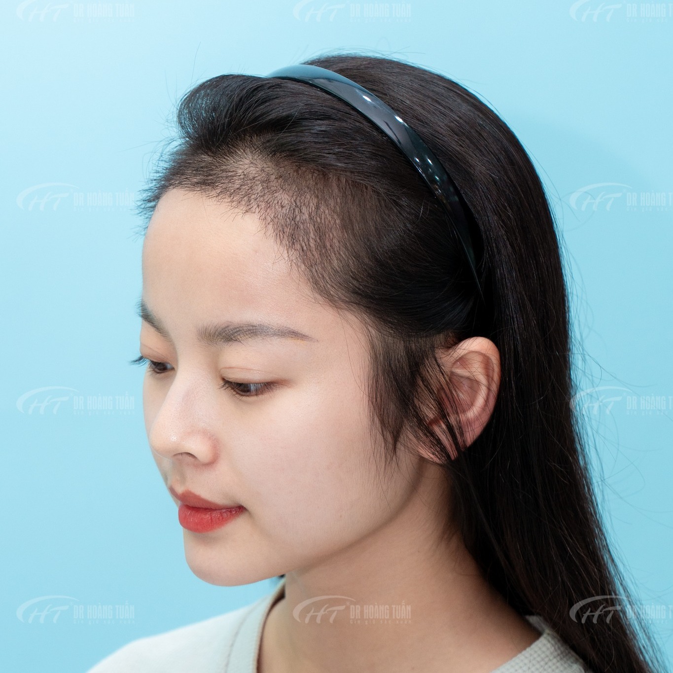 Cấy tóc
