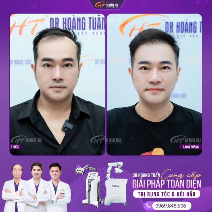 Cấy tóc cho người hói: Giải pháp y khoa tiên tiến hiệu quả và bền vững