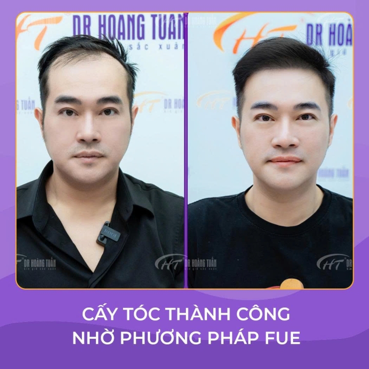Cấy tóc bao lâu thì mọc lại? Toàn bộ hành trình hồi sinh mái tóc từ A-Z