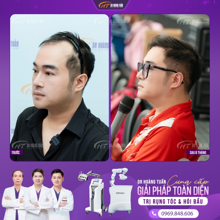 Hói đầu di truyền như thế nào? Cách phòng ngừa và làm chậm hói đầu di truyền