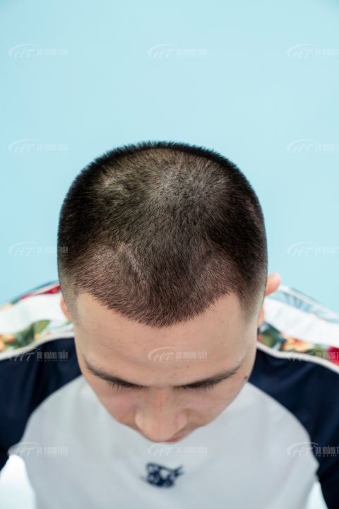 Cấy tóc hạ đường chân tóc dành cho ai? Chi phí cấy hạ đường chân tóc mới nhất