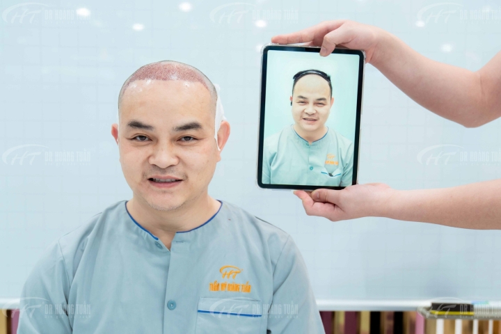 ĐIỀU TRỊ RỤNG TÓC, HÓI ĐẦU VÀ NHỮNG ĐIỀU BẠN CẦN BIẾT || PHÒNG KHÁM ĐA KHOA HOÀNG TUẤN