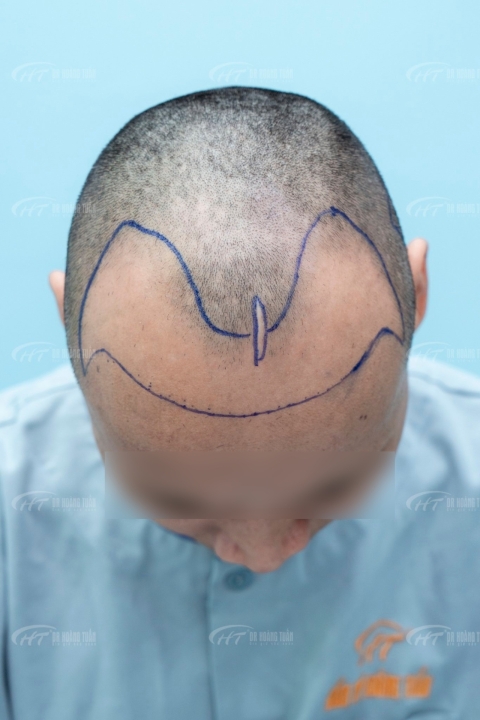 Nguyên nhân hói chữ m và cách khắc phục sao cho hiệu quả nhất