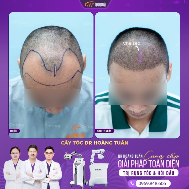 Cấy tóc Dr Hoàng Tuấn – Địa chỉ cấy hạ đường chân tóc uy tín tại Hà Nội