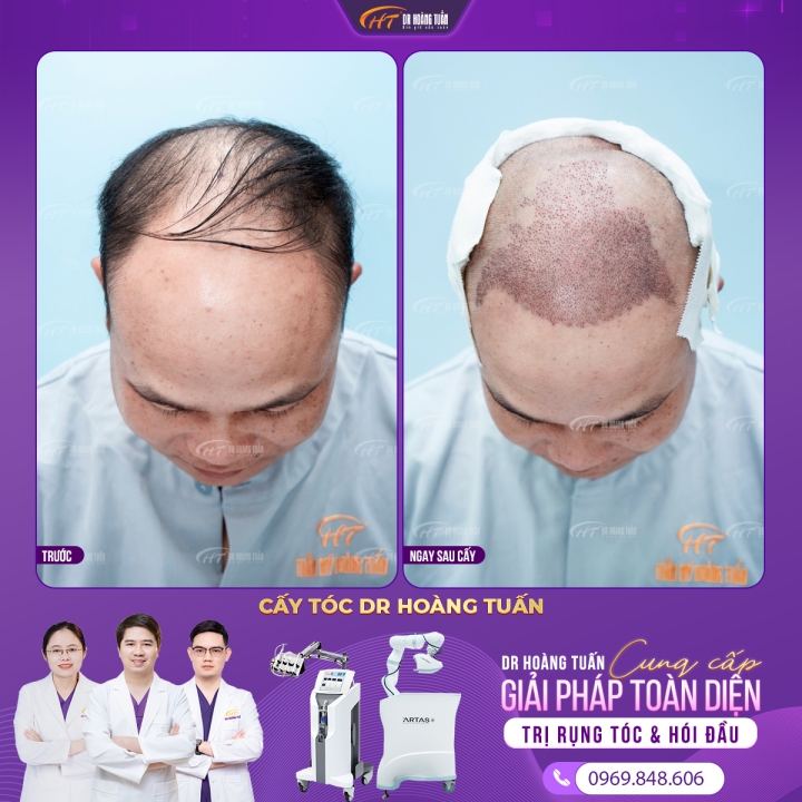 Hói đầu do đâu? Hói đầu có chữa được không?