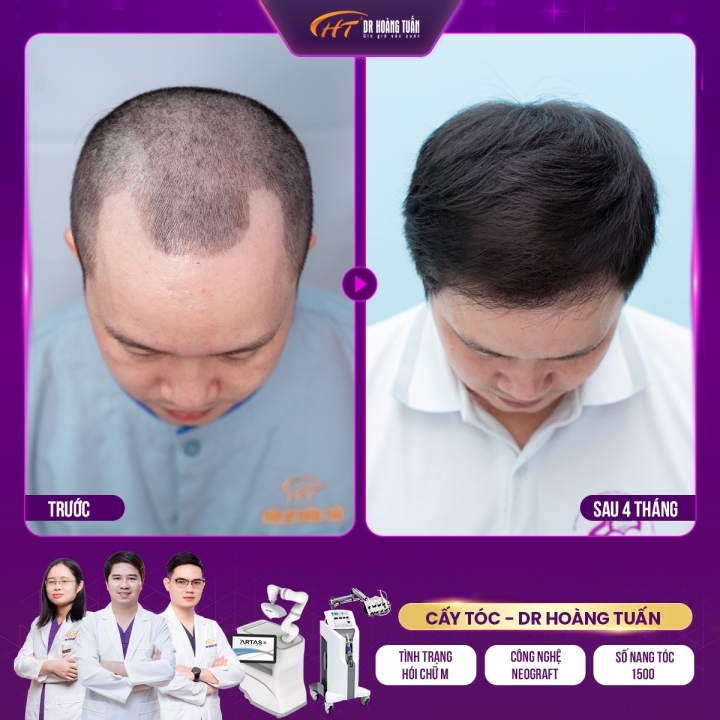 Cấy tóc có hiệu quả không, có được vĩnh viễn không?